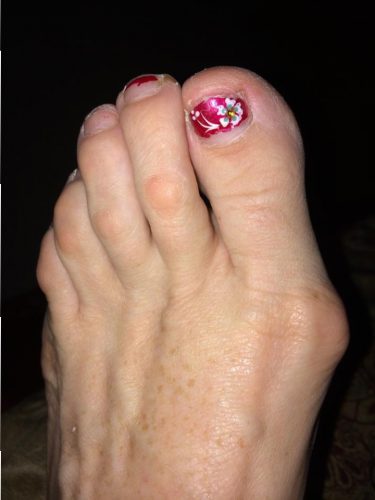 bunion on big toe